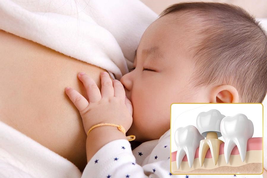 Đang cho con bú có bọc răng sứ được không?- Ảnh 2. Đang cho con bú có bọc răng sứ được không?- Ảnh 2.