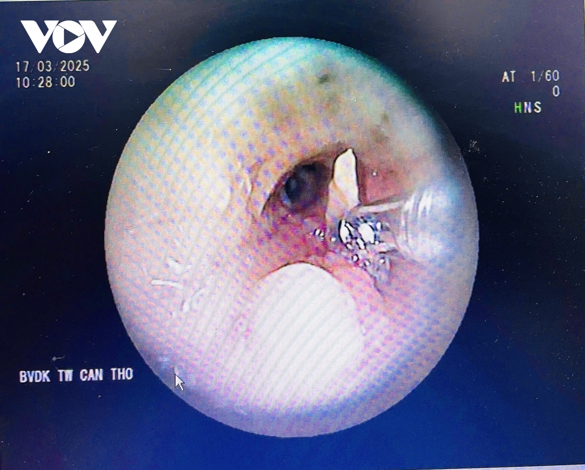 Mảnh xương vịt nằm trong phổi suốt 2 năm gây biến chứng nặng - Ảnh 2. Mảnh xương vịt nằm trong phổi suốt 2 năm gây biến chứng nặng - Ảnh 2.