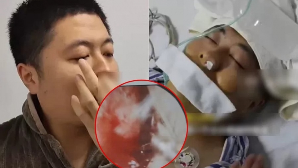 Mảnh xương vịt nằm trong phổi suốt 2 năm gây biến chứng nặng - Ảnh 3. Mảnh xương vịt nằm trong phổi suốt 2 năm gây biến chứng nặng - Ảnh 3.