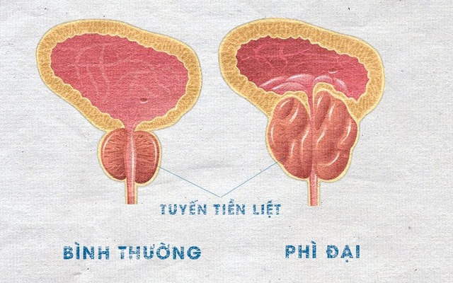 Người đàn ông không thể tiểu tiện vì bị u tiền liệt tuyến, nam giới sau 50 tuổi có dấu hiệu này cần cảnh giác- Ảnh 3.