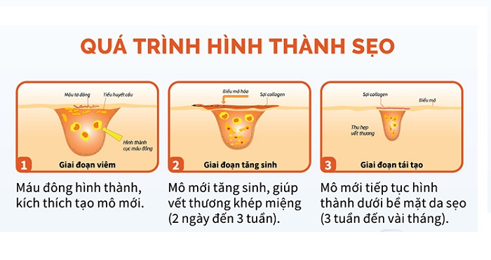Góc giải đáp: Sẹo mổ đẻ có hết được hoàn toàn mà không cần xâm lấn? - Ảnh 6.
