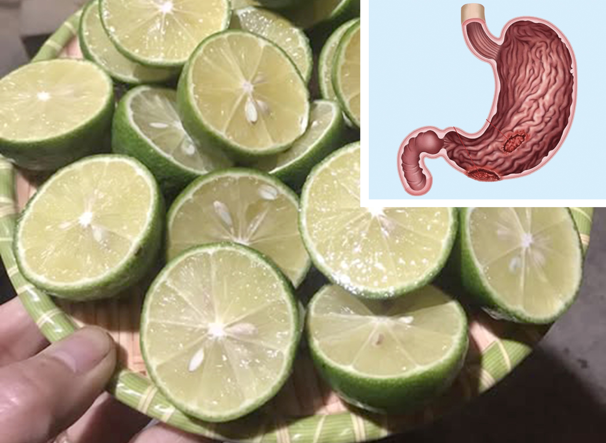 Cẩn trọng lời đồn thải độc bằng nước cốt chanh - Ảnh 1.