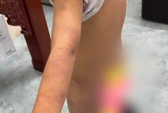 Làm rõ nghi vấn nam sinh lớp 6 bị bạo hành với nhiều vết bầm tím trên cơ thể- Ảnh 1. Làm rõ nghi vấn nam sinh lớp 6 bị bạo hành với nhiều vết bầm tím trên cơ thể- Ảnh 1.