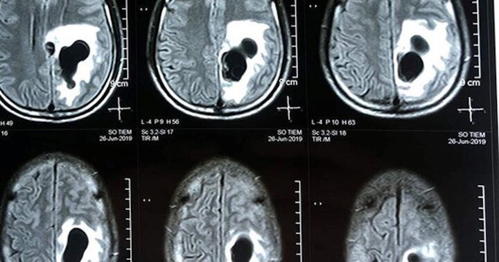 Co giật, méo miệng vì sán làm tổ trong não: Nguyên nhân từ món ăn khoái khẩu của người Việt - Ảnh 1.